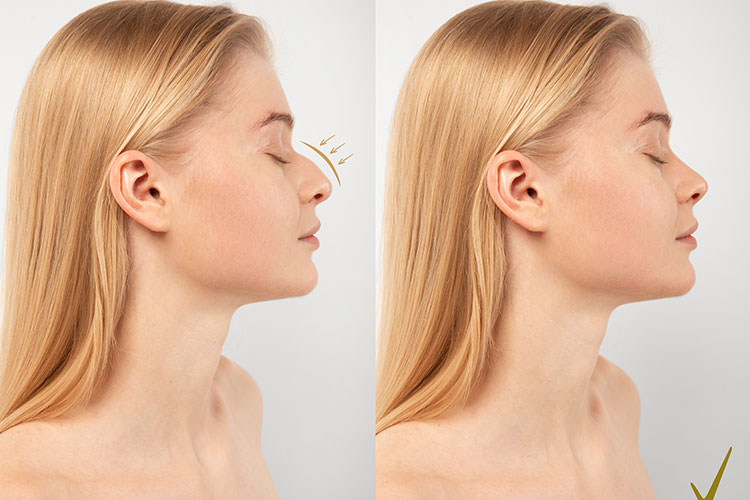 Septorhinoplasty