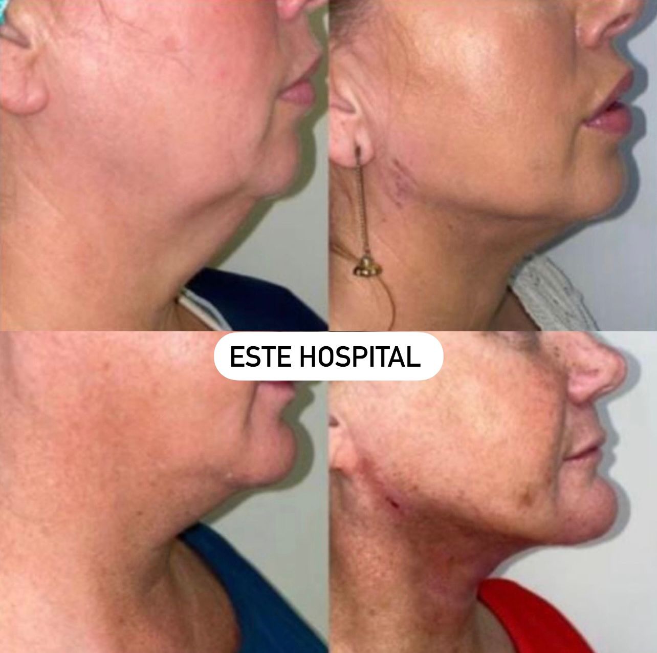 chin-lipo