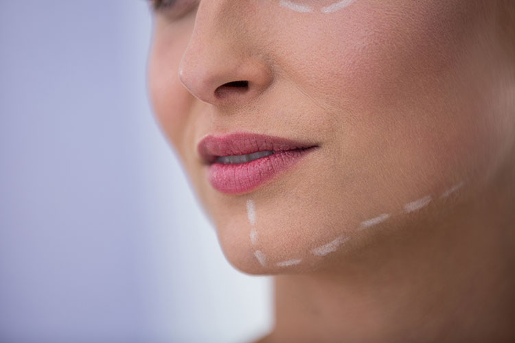 chin-lipo