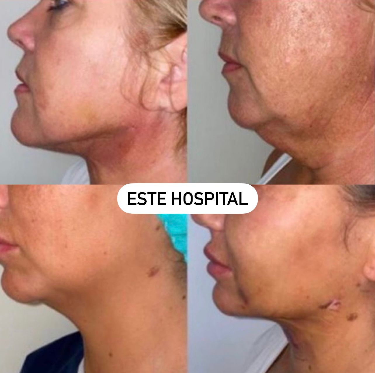 chin-lipo2