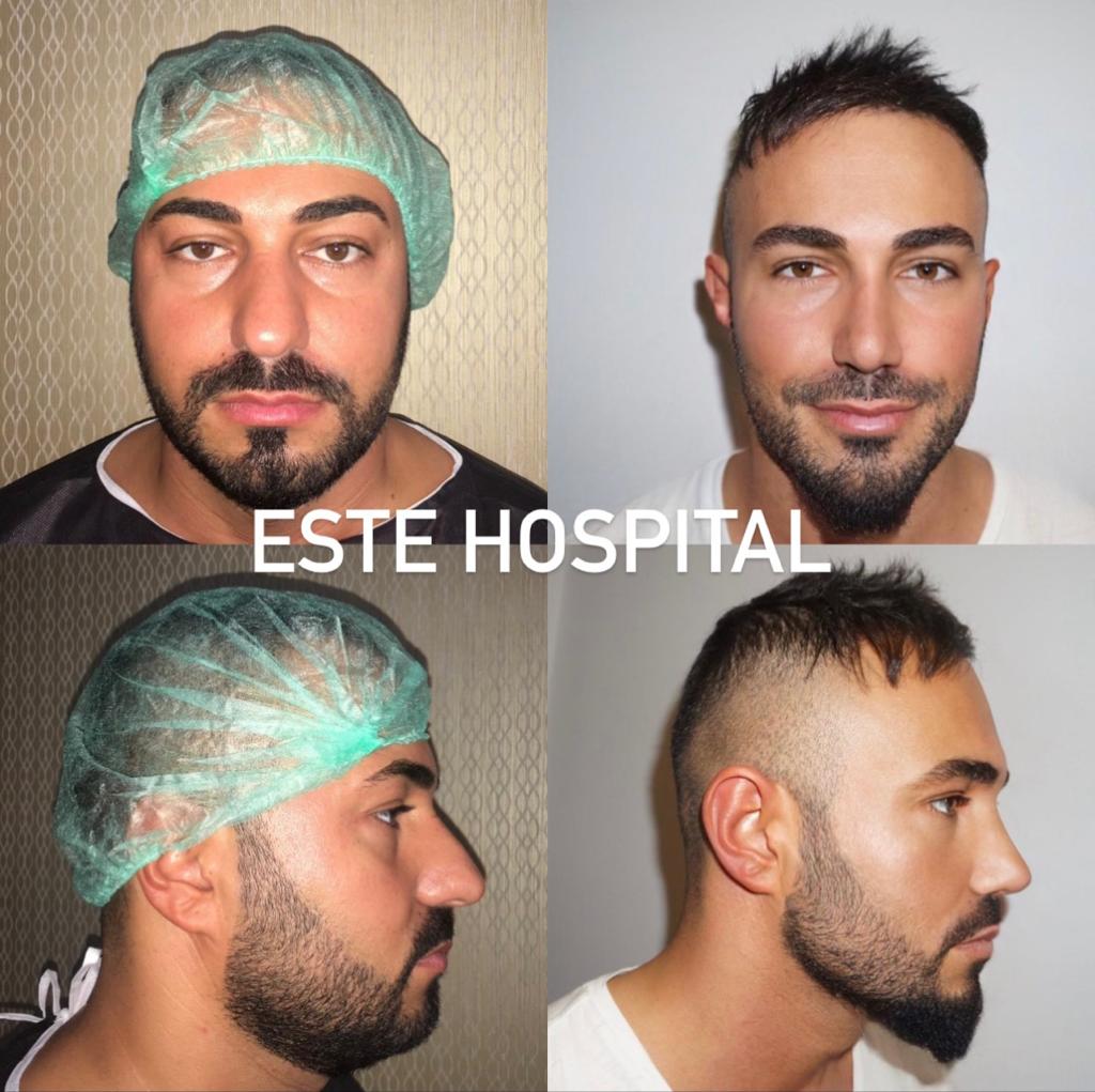 chin-lipo3