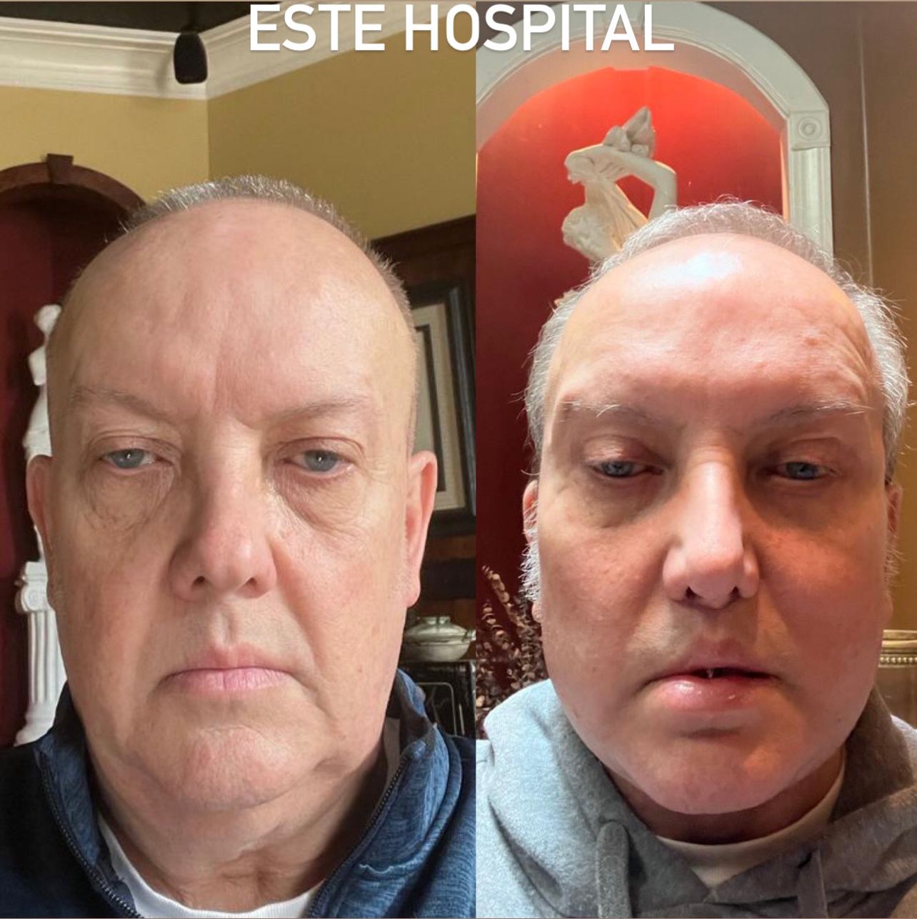 face-and-neck-lift3