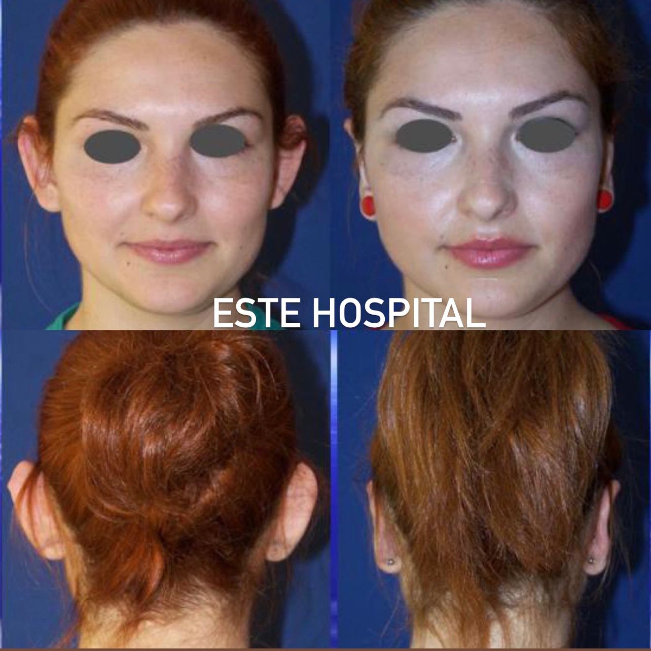 otoplasty