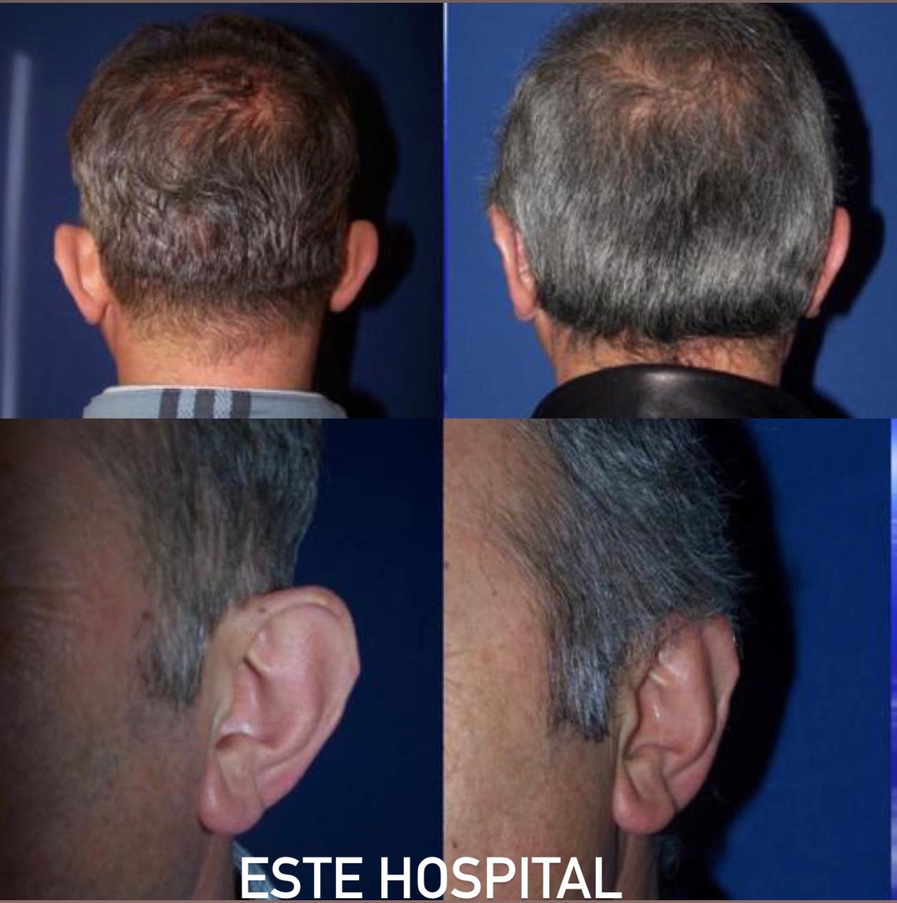 otoplasty2