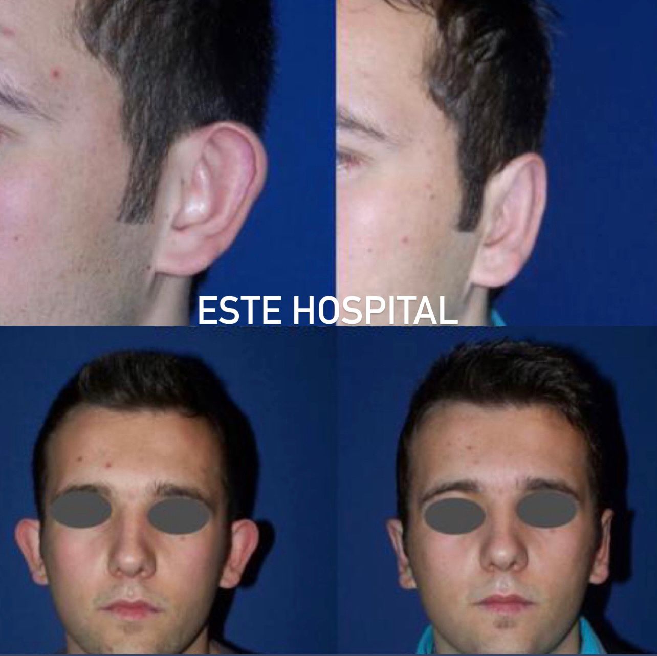 otoplasty3