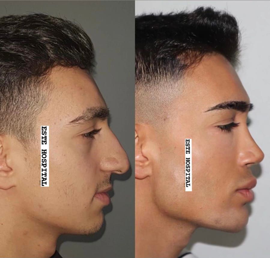 rhinoplasty