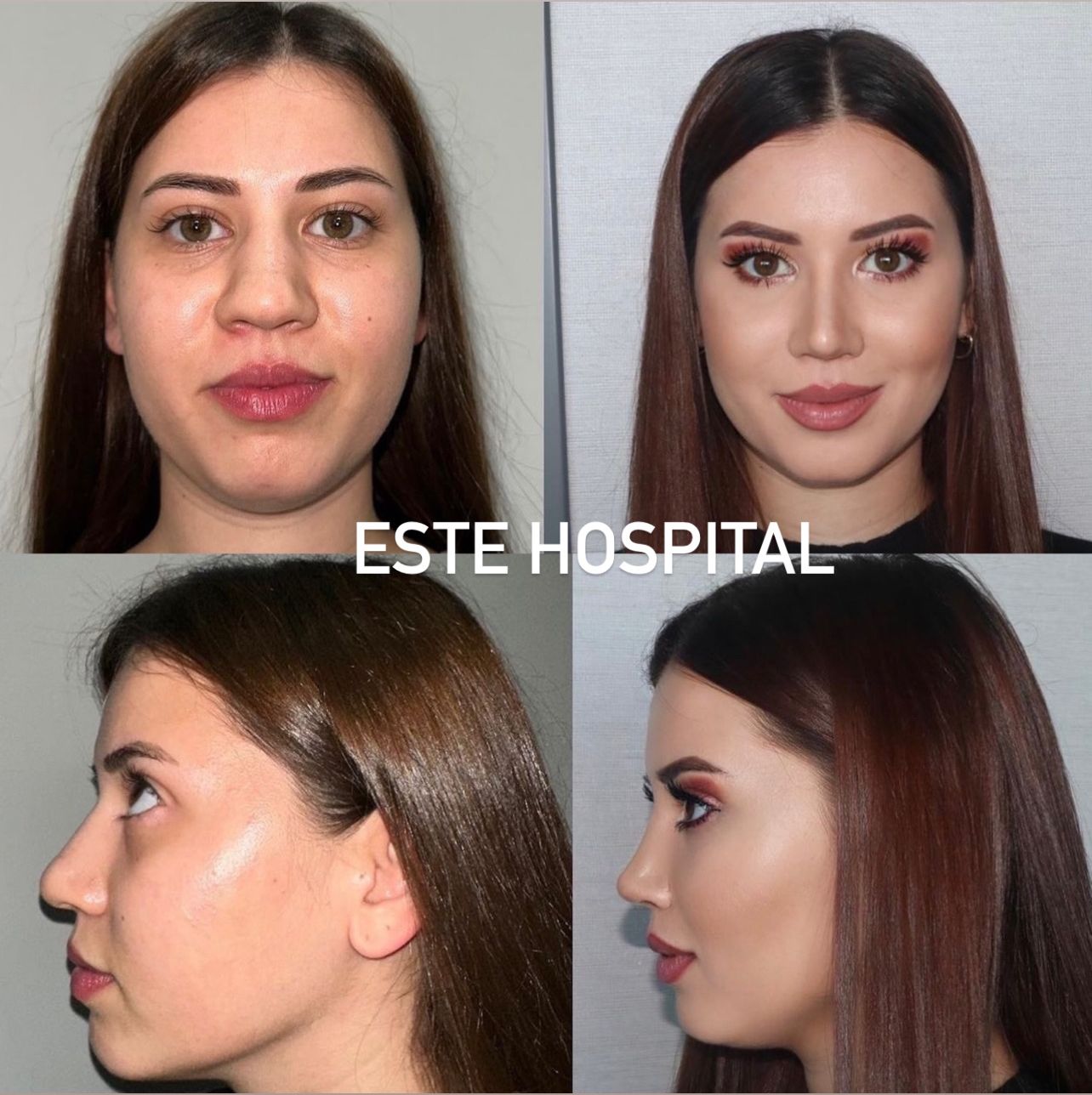 bishectomi-cheek-lift