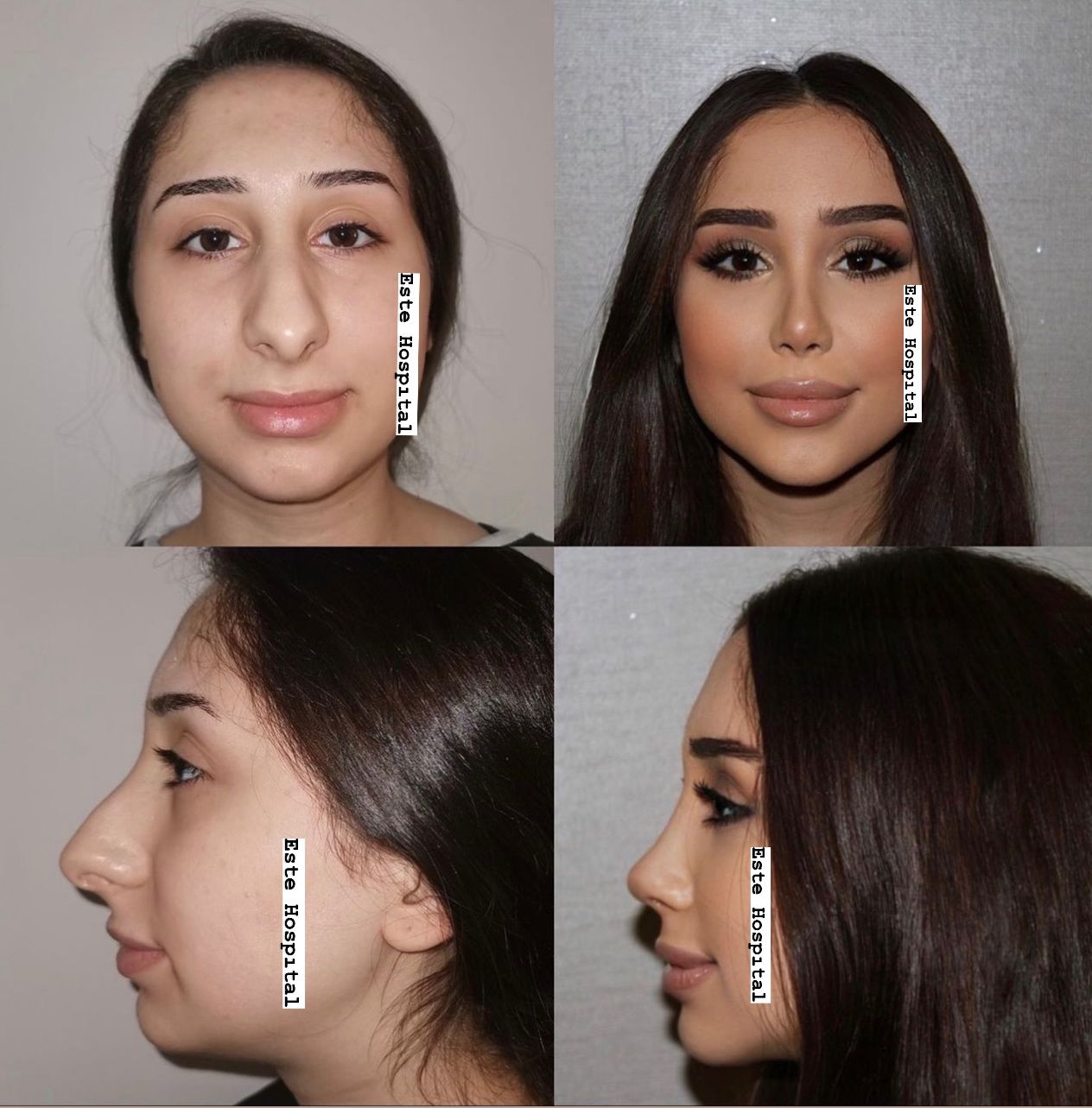 bishectomi-v-shape-cheek-lift