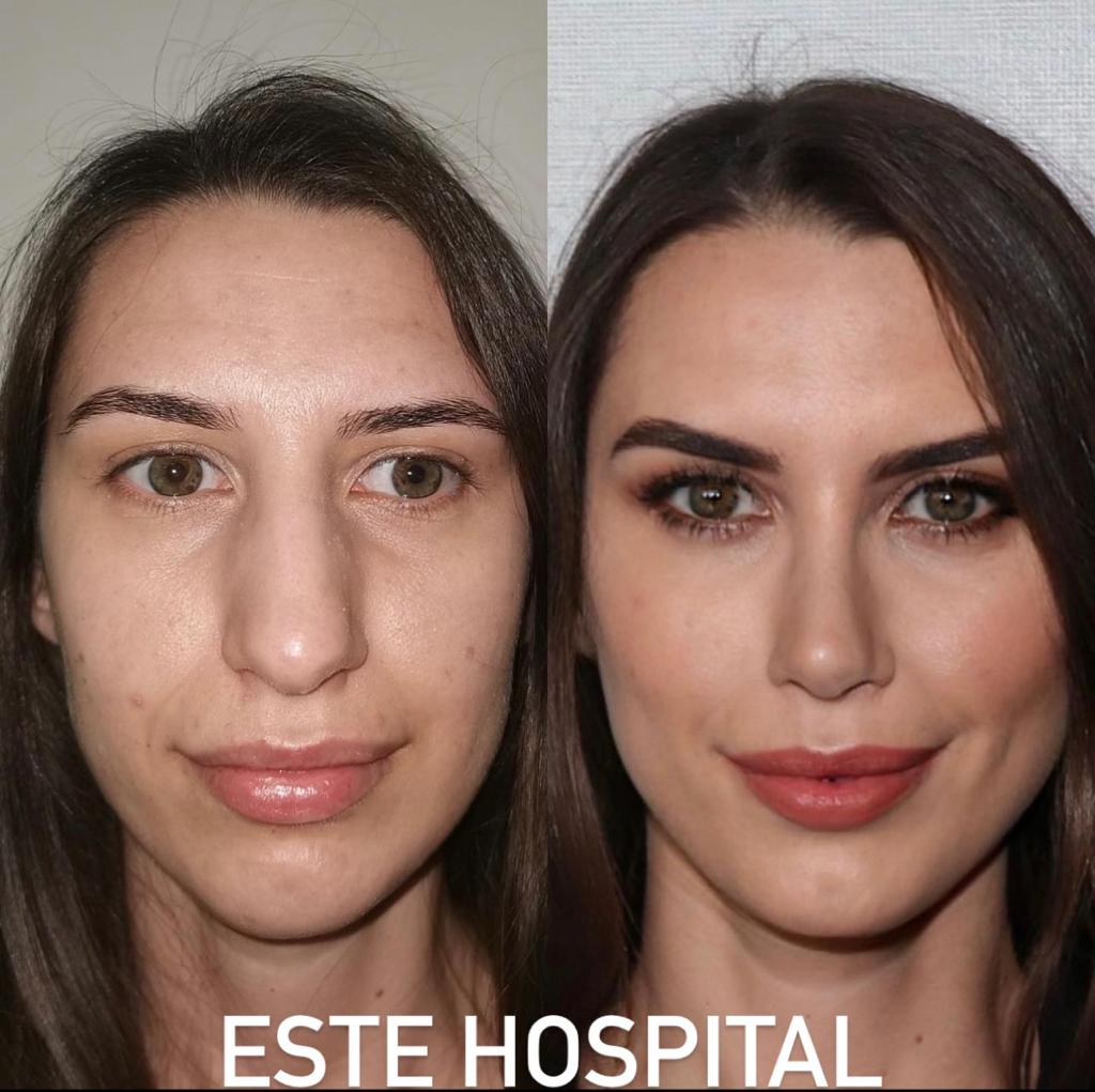 dimple-surgery