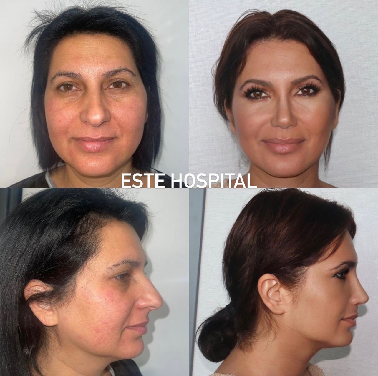 face-neckLift1