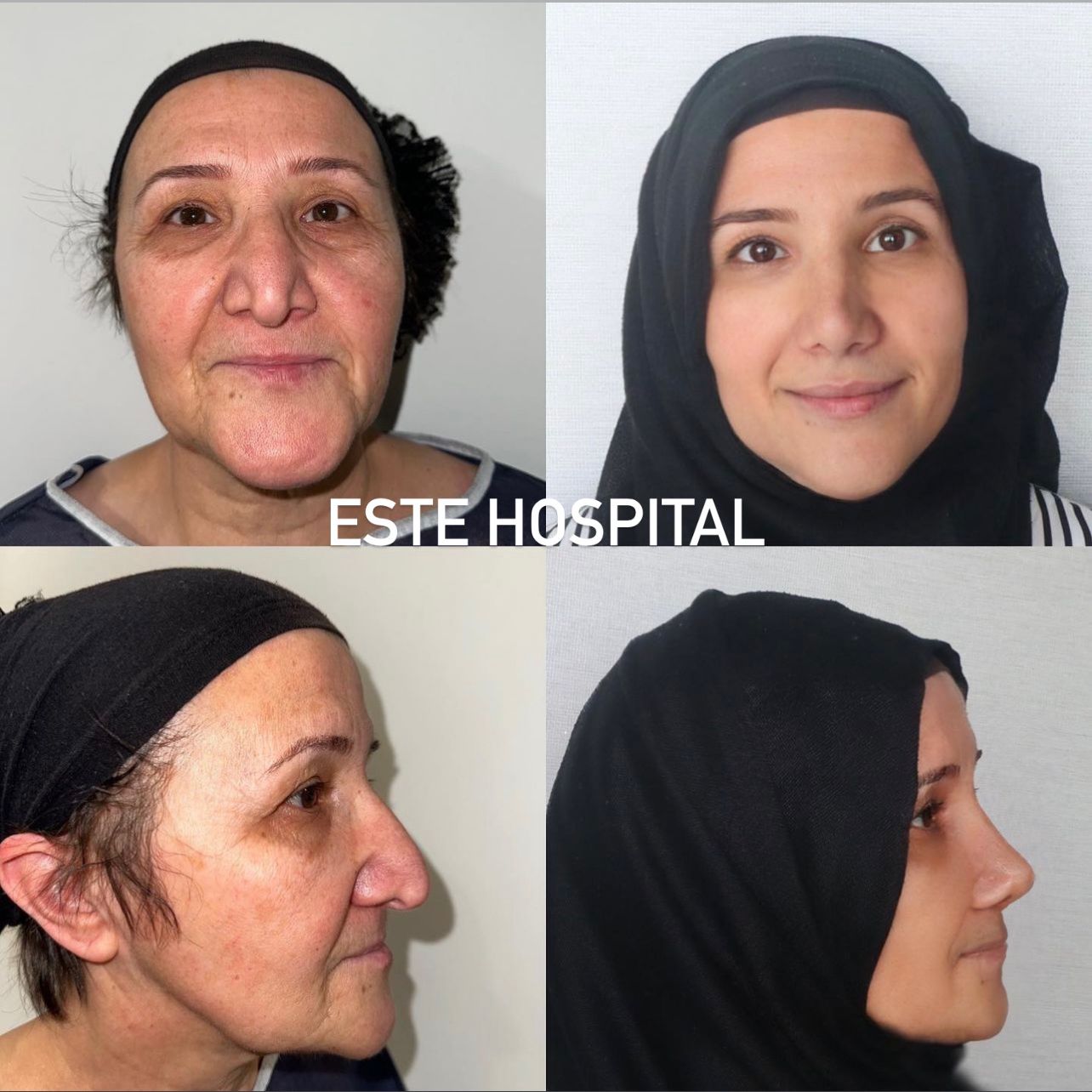 face-neckLift2