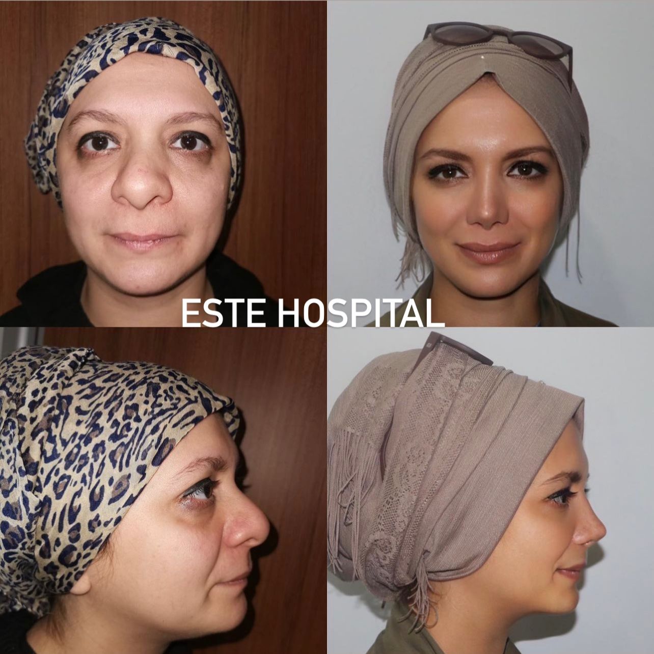 face-neckLift3
