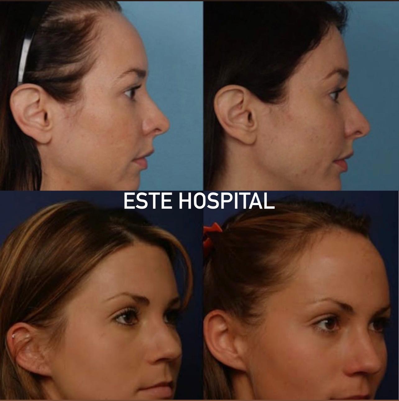 forehead-lift-before-after