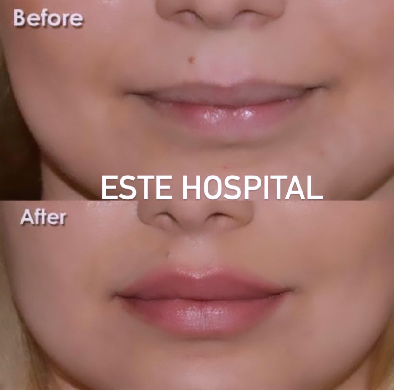 lip-lift1