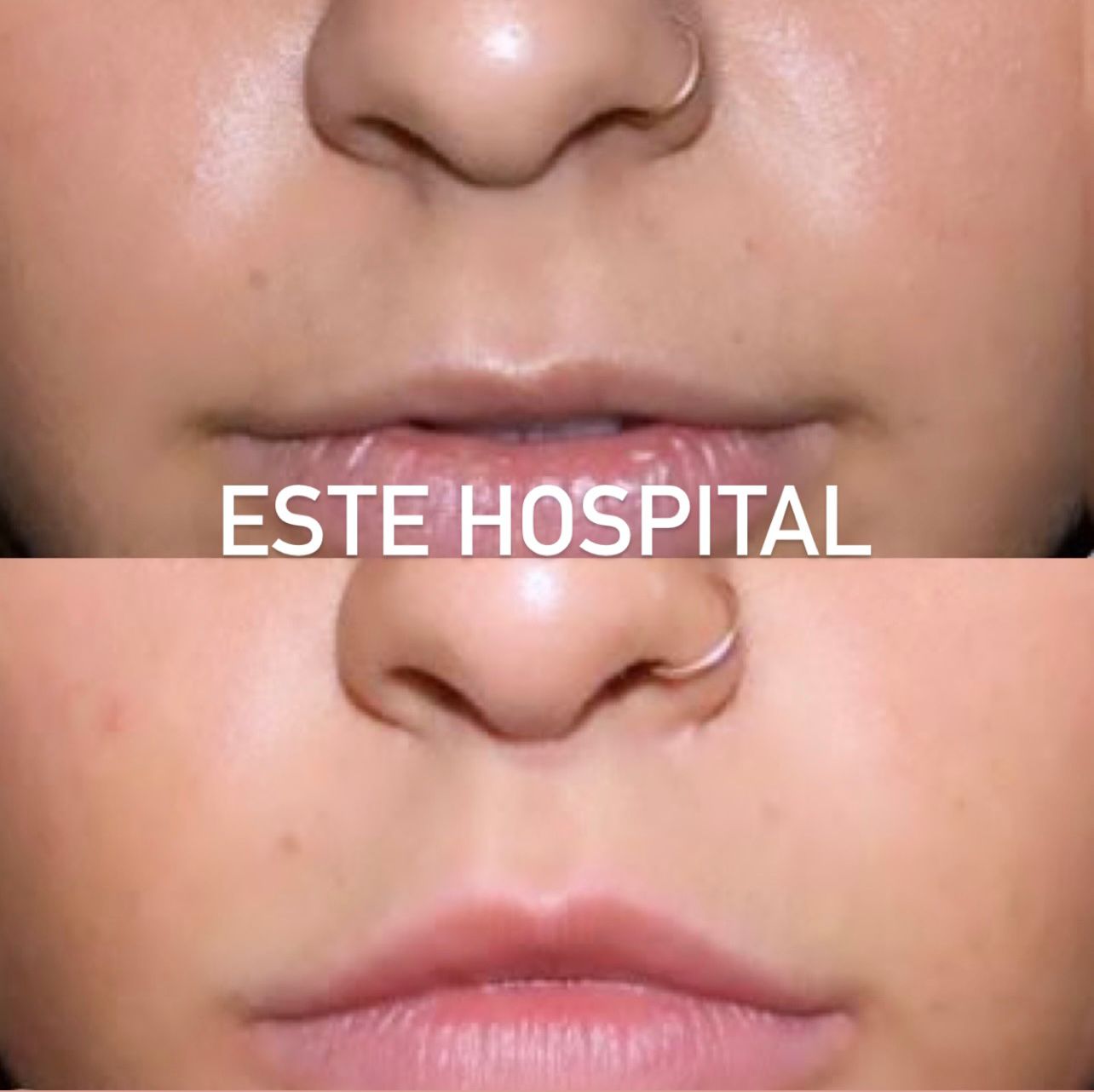 lip-lift2