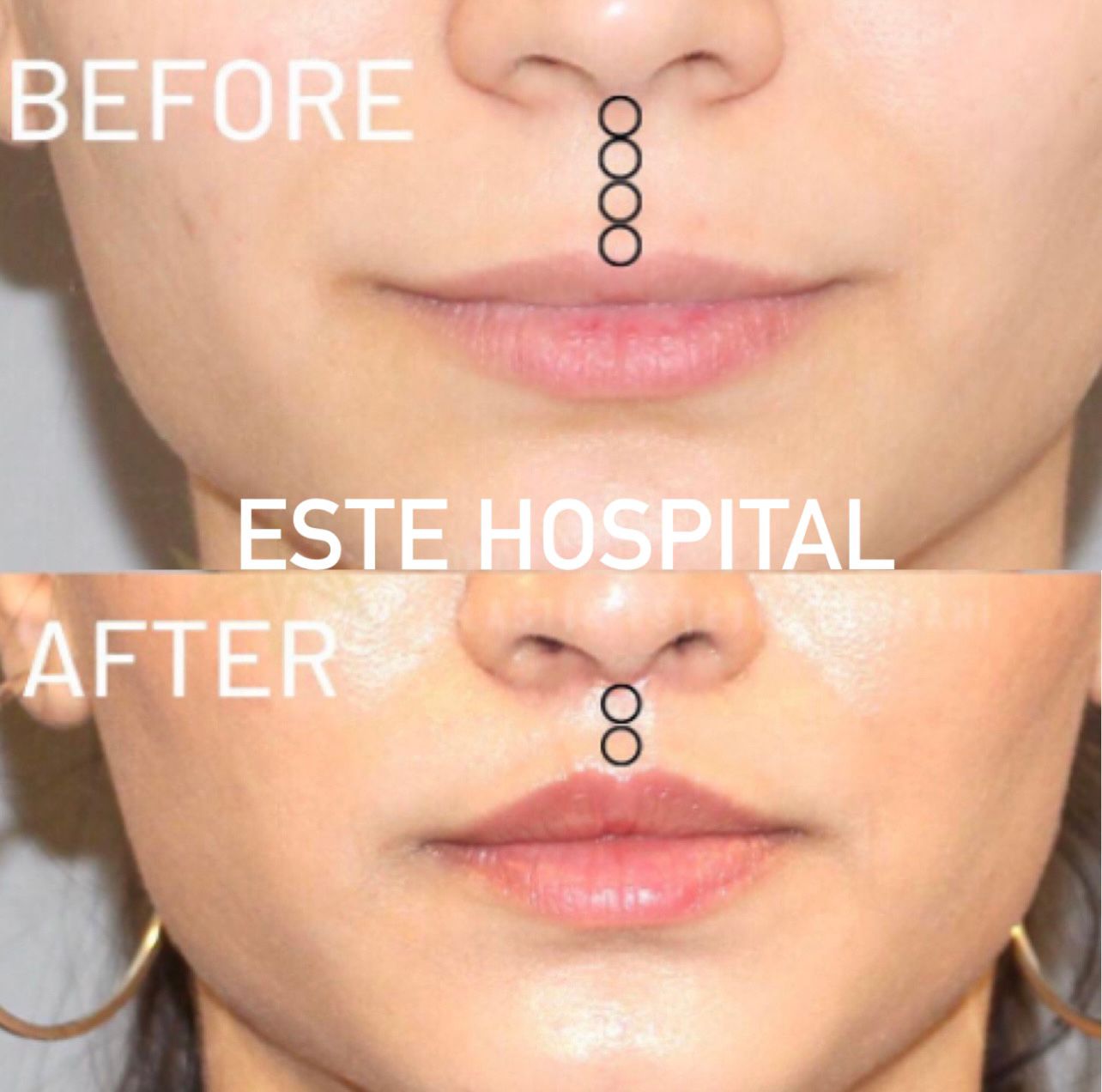 lip-lift3