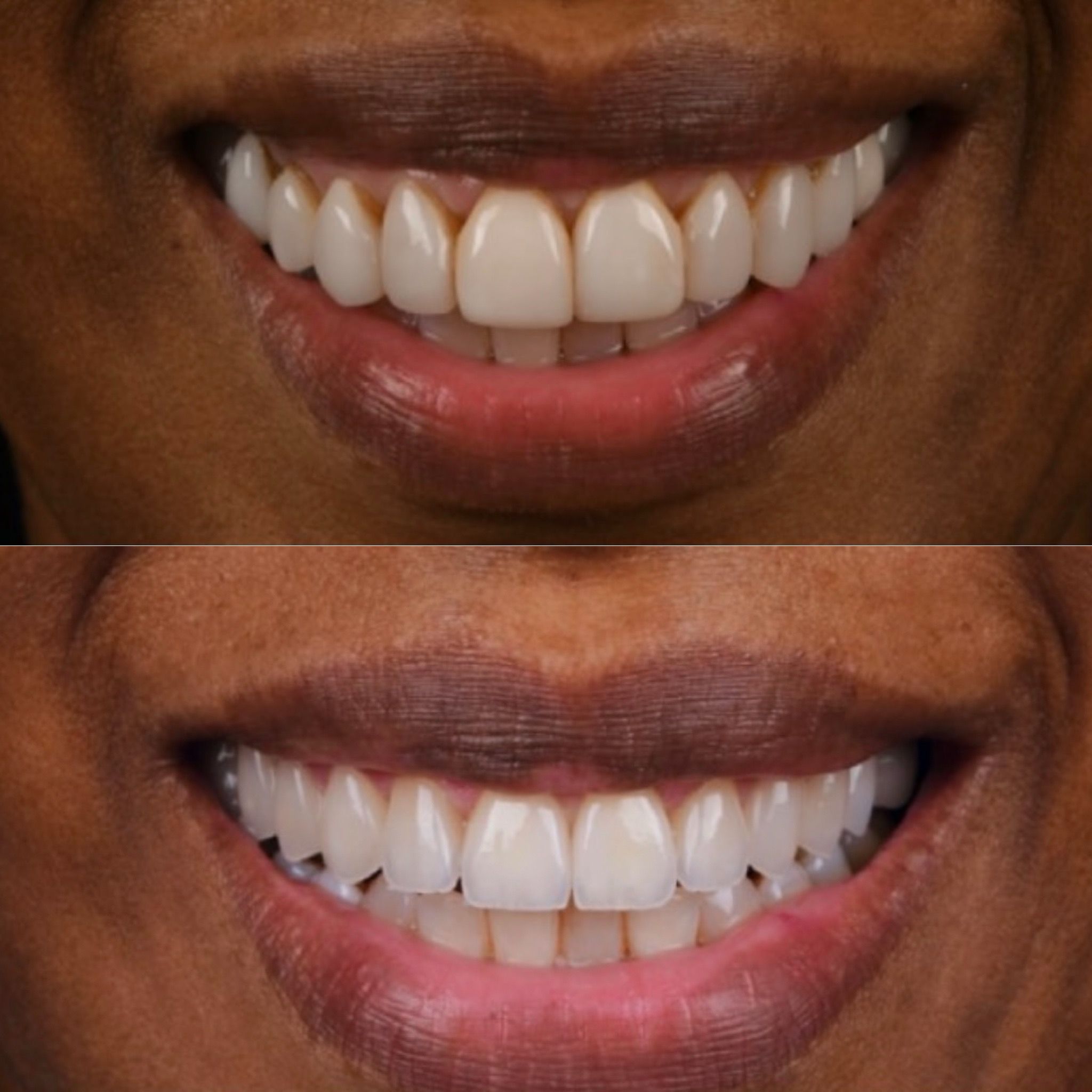 teeth1