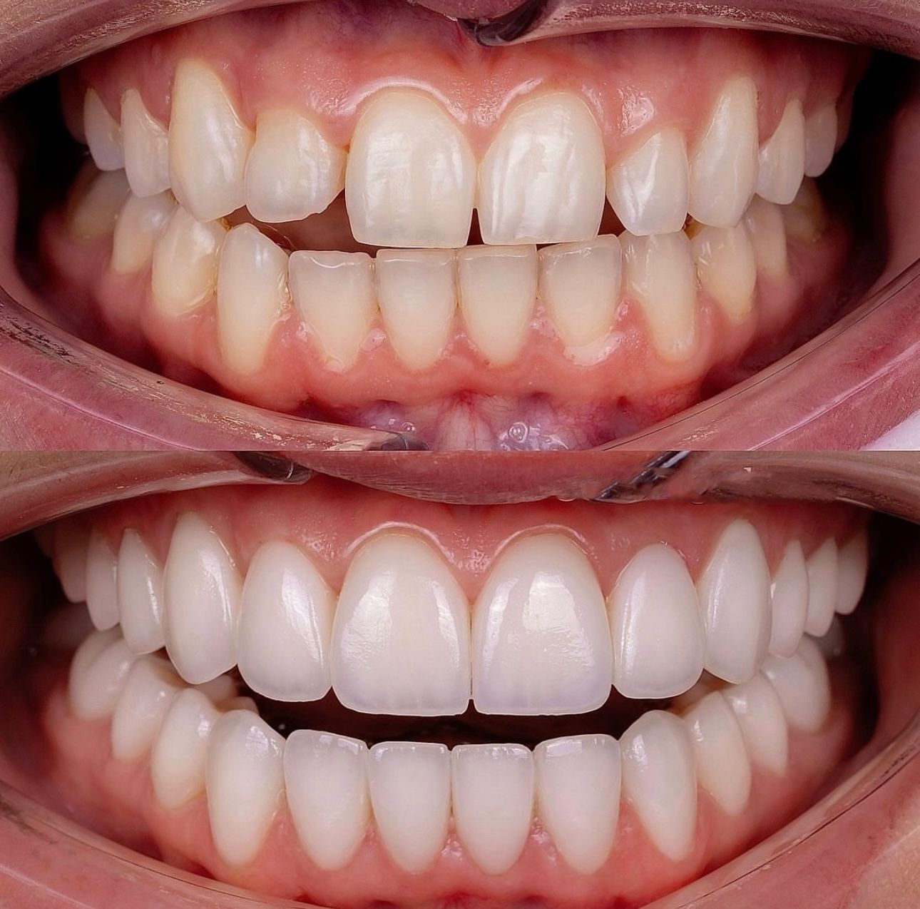 teeth3
