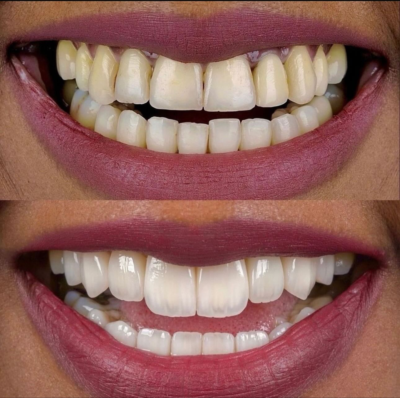 teeth4
