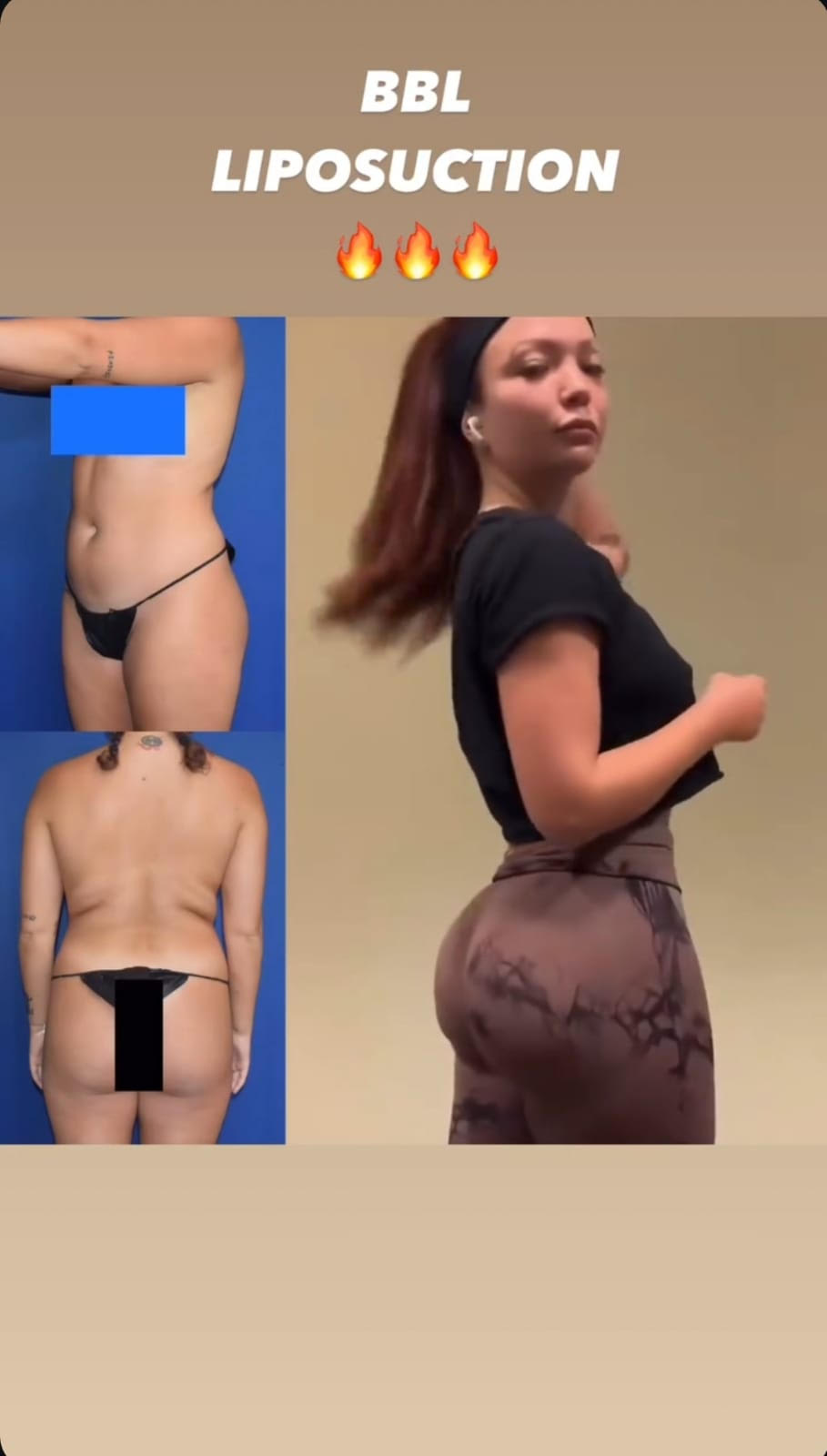bbl-liposuction