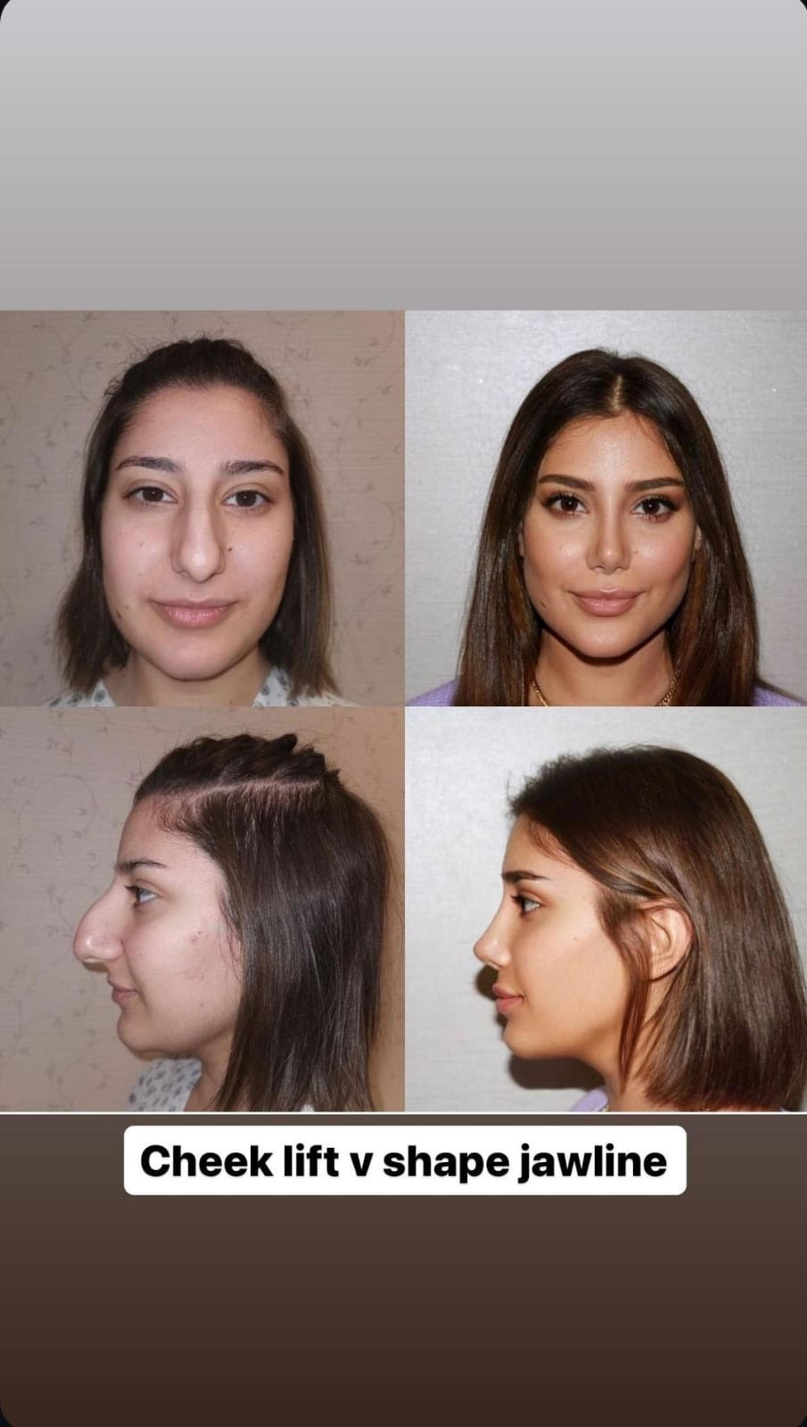 cheeklift-vshapejawline