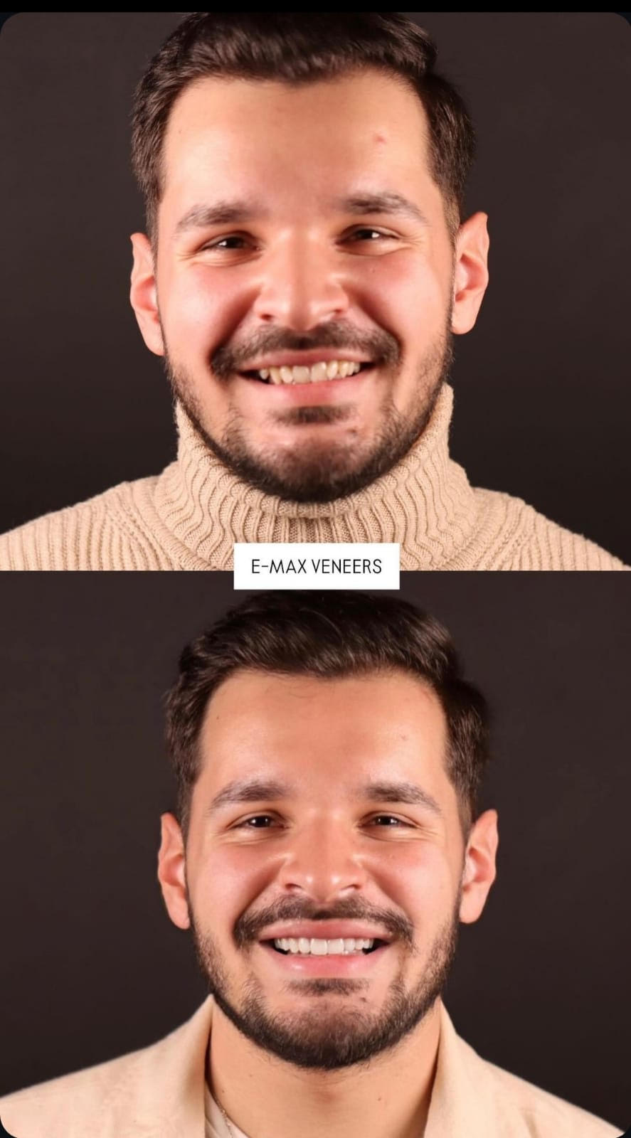 emaxveneers2