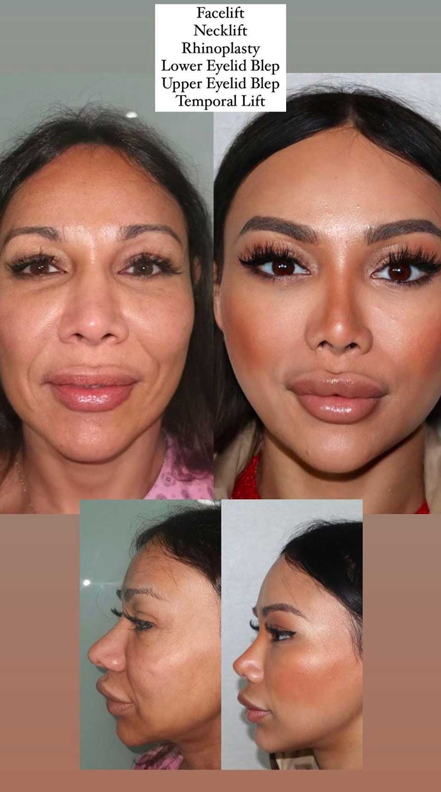 facelift2