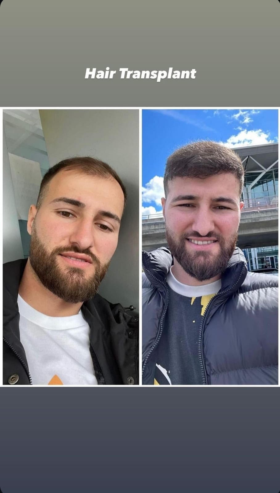 hairtransplant