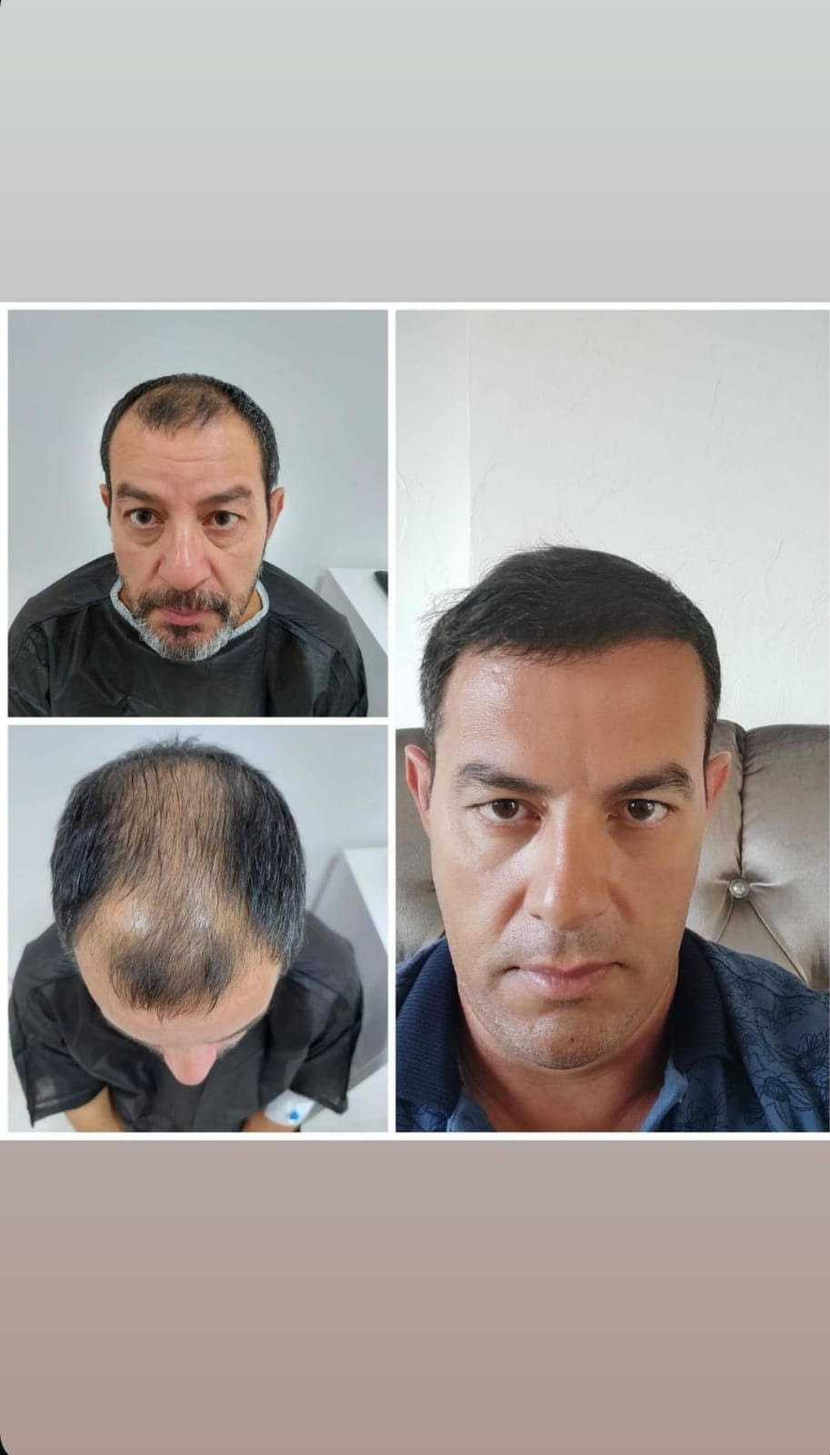 hairtransplant2