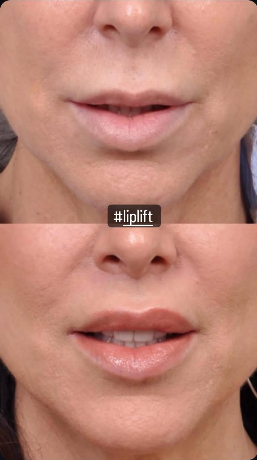 liplift