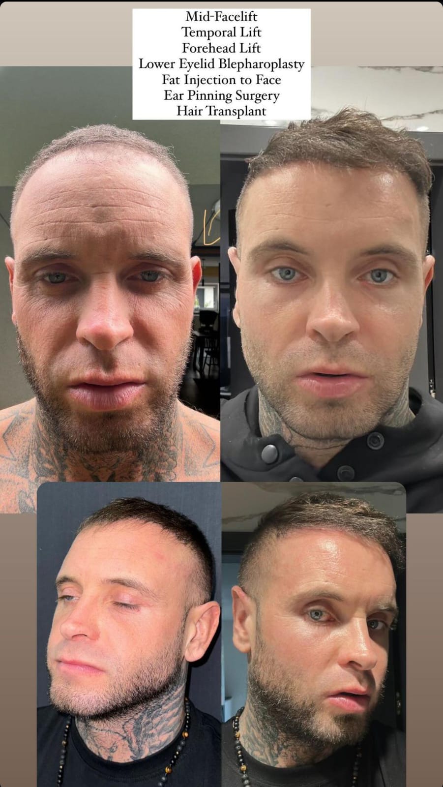 midfacelift