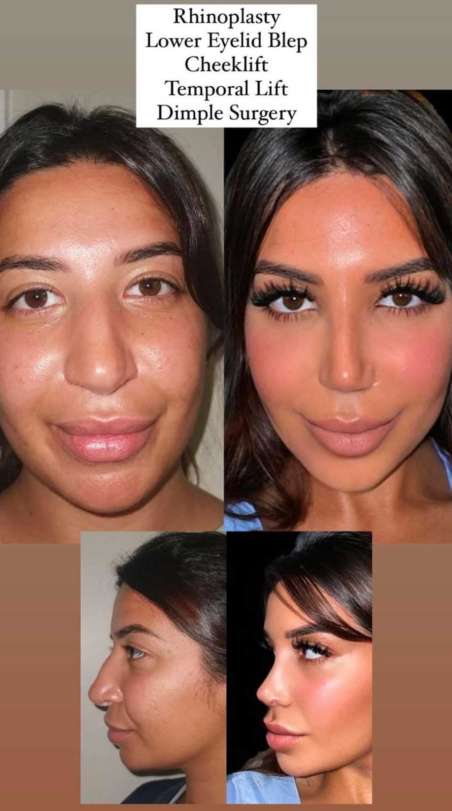 rhinoplasty-lowereyelid-cheeklift-temporallift-dimplesurgery2