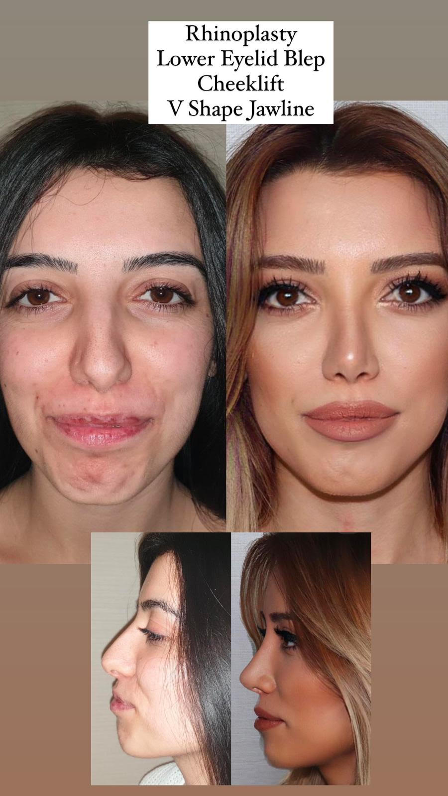 rhinoplasty-lowereyelid-cheeklift-vshapejawline