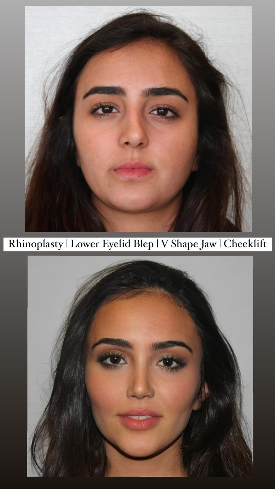 rhinoplasty-lowereyelid-vshapejawline-cheeklift