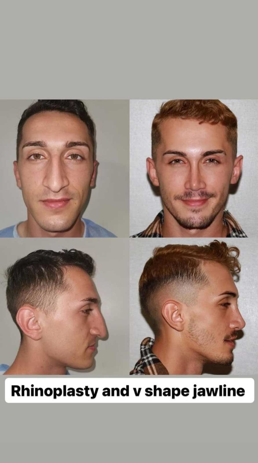 rhinoplasty-vshapejawline2