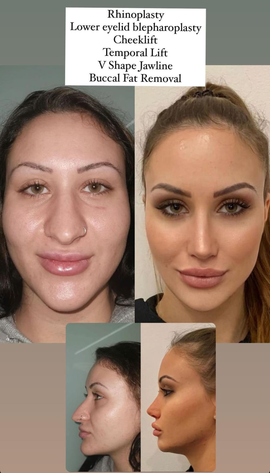 rhinoplasty
