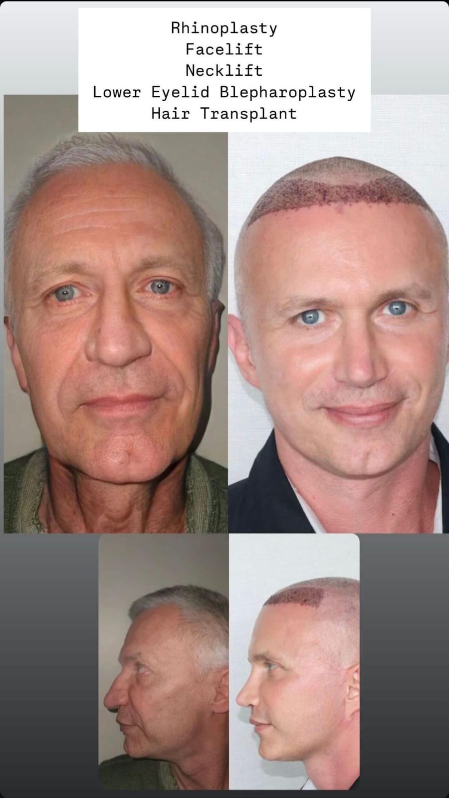 rhinoplasty2