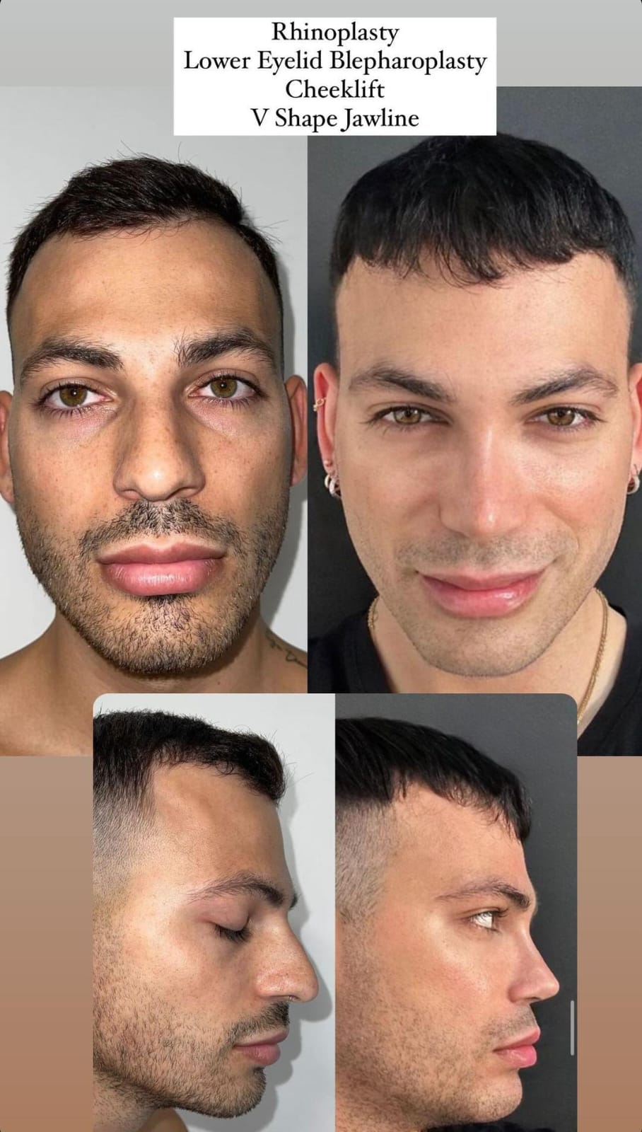 rhinoplasty3