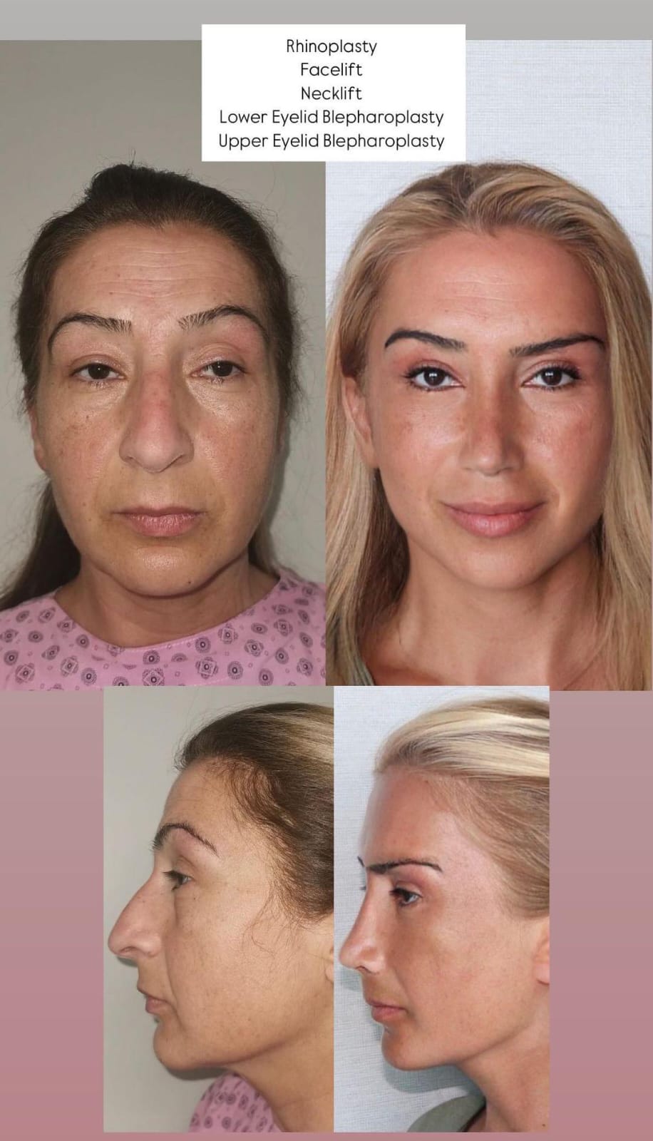 rhinoplasty4