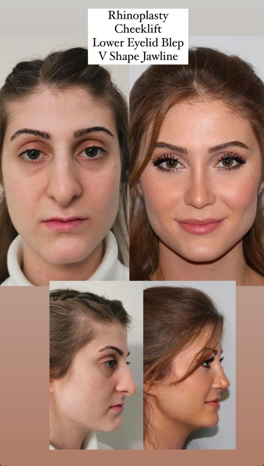 rhinoplasty5