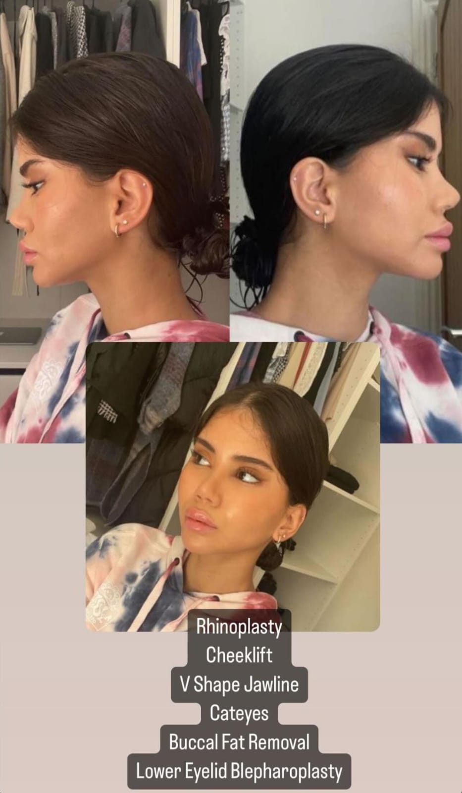 rhinoplasty6
