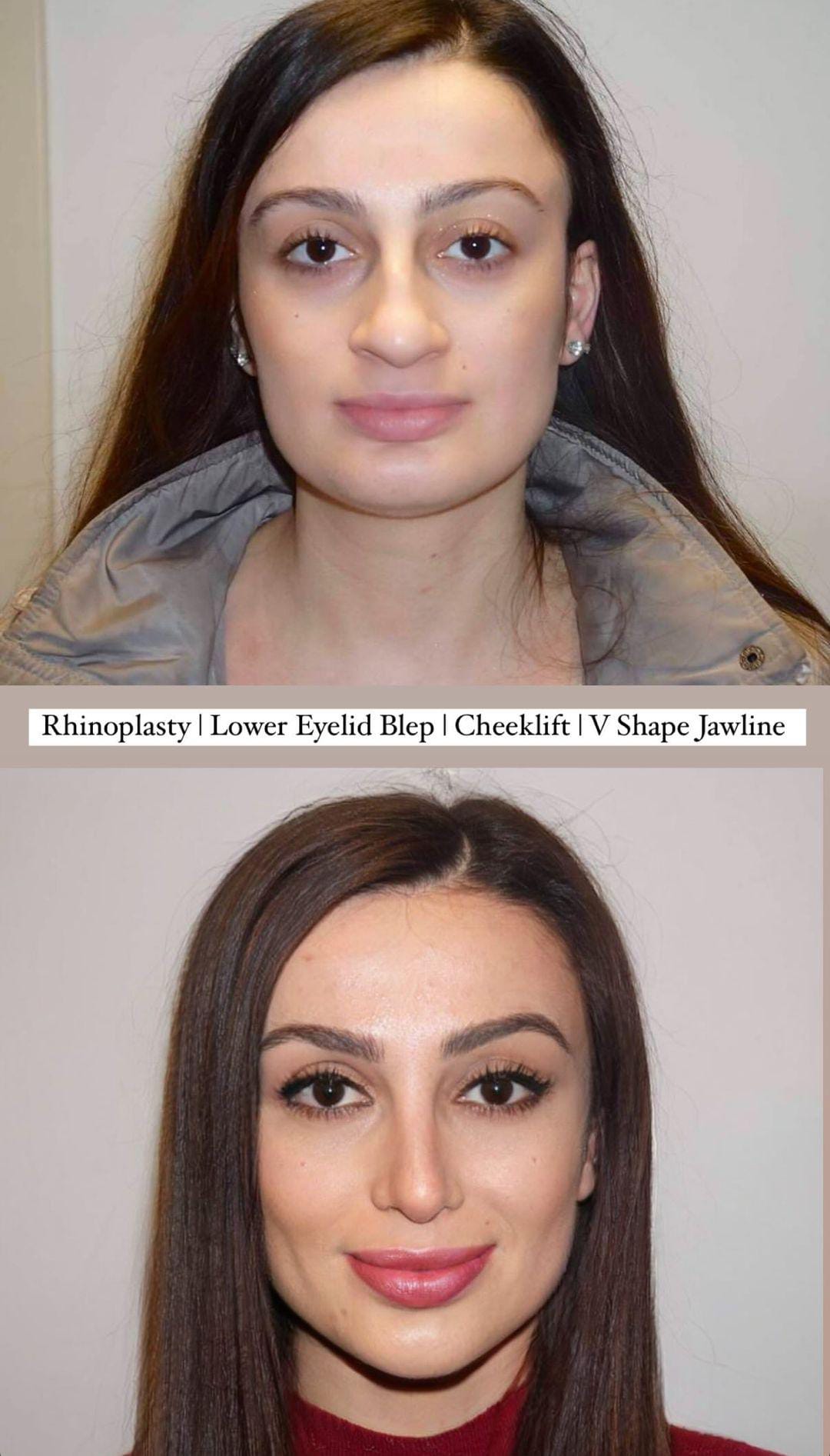rhinoplasty7