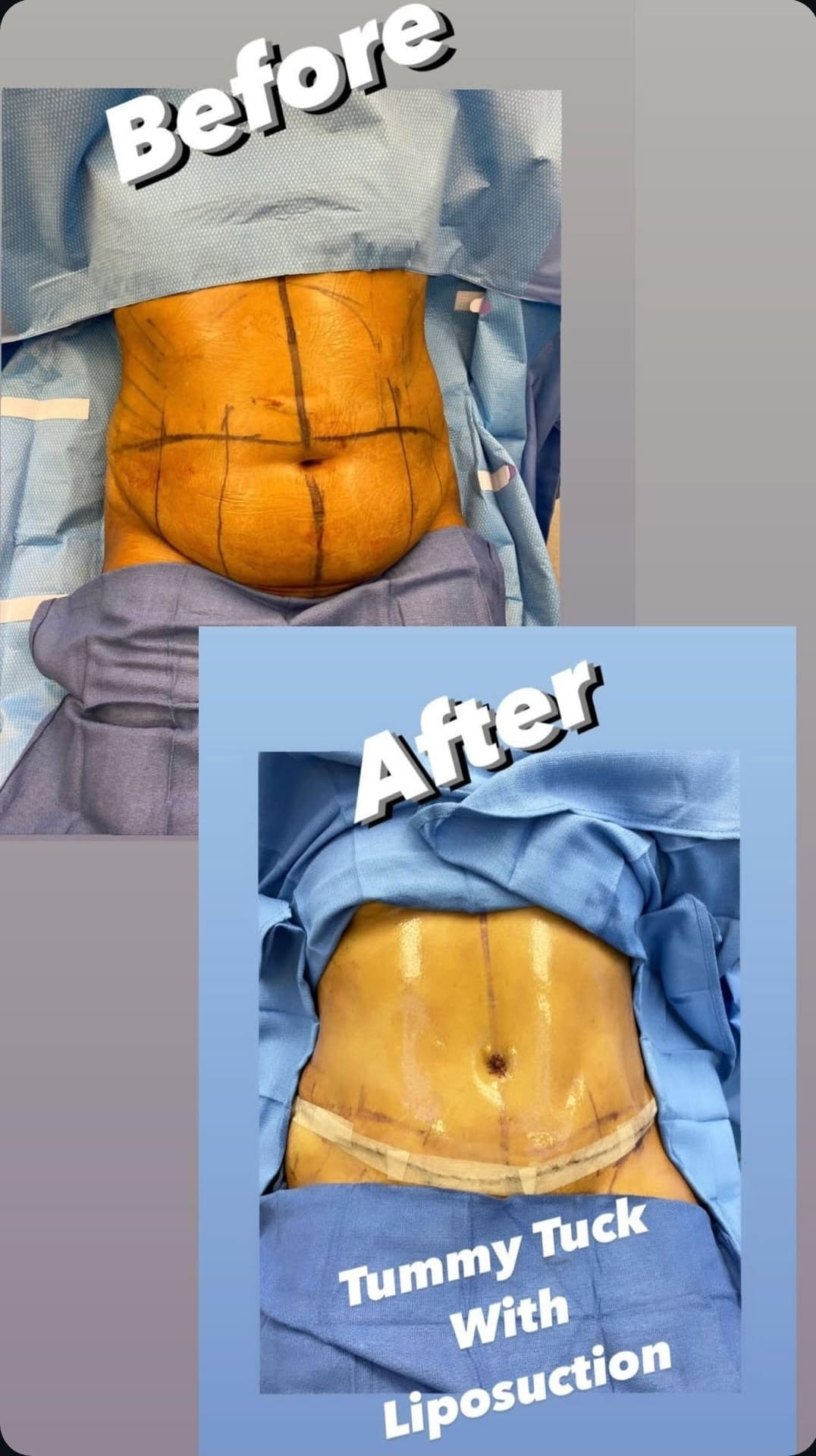 tummy-tuck